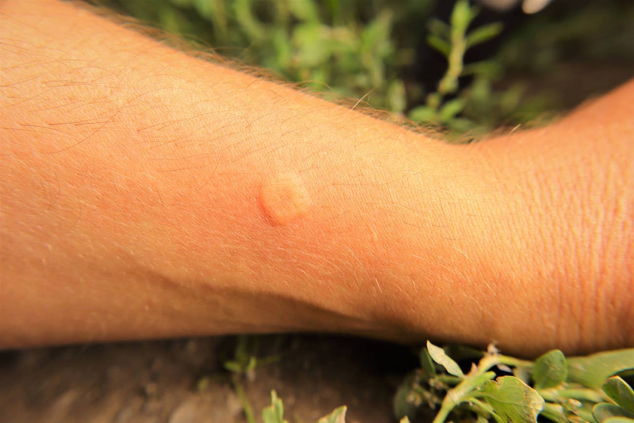 Yellow Jacket Season What To Do If You Get Stung